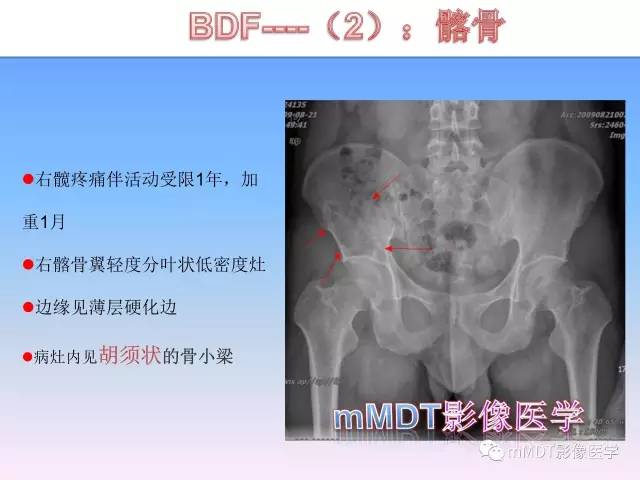 轻松诊断这三个不常见位置的骨巨细胞瘤