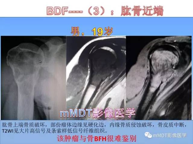 轻松诊断这三个不常见位置的骨巨细胞瘤