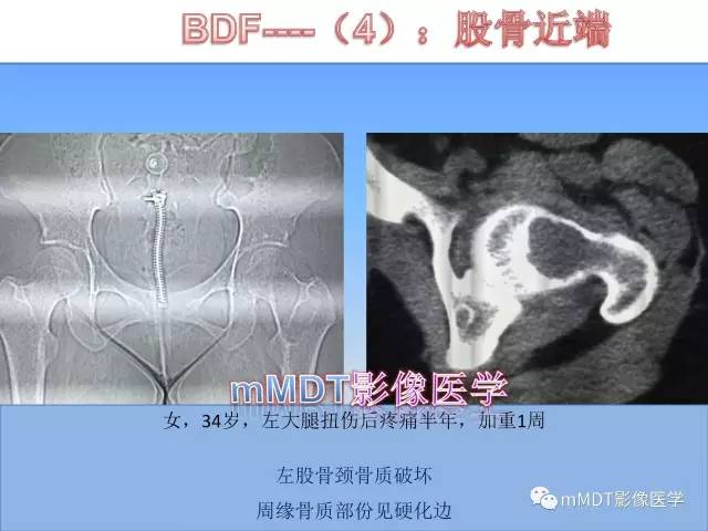 轻松诊断这三个不常见位置的骨巨细胞瘤