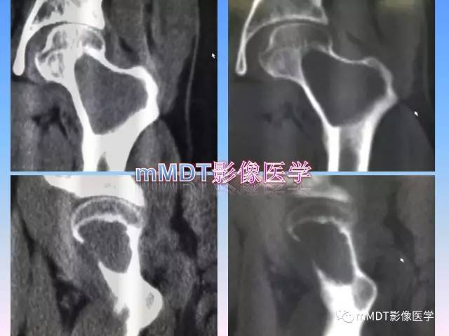 轻松诊断这三个不常见位置的骨巨细胞瘤
