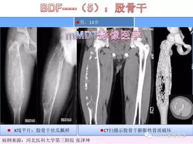 轻松诊断这三个不常见位置的骨巨细胞瘤
