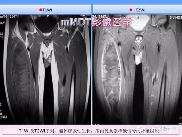 轻松诊断这三个不常见位置的骨巨细胞瘤