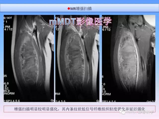 轻松诊断这三个不常见位置的骨巨细胞瘤