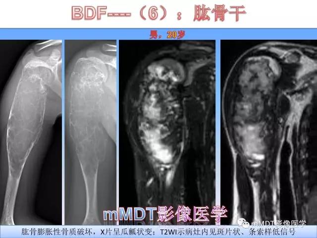 轻松诊断这三个不常见位置的骨巨细胞瘤