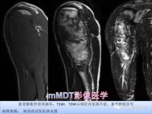 轻松诊断这三个不常见位置的骨巨细胞瘤