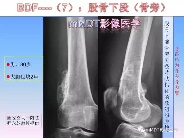 轻松诊断这三个不常见位置的骨巨细胞瘤
