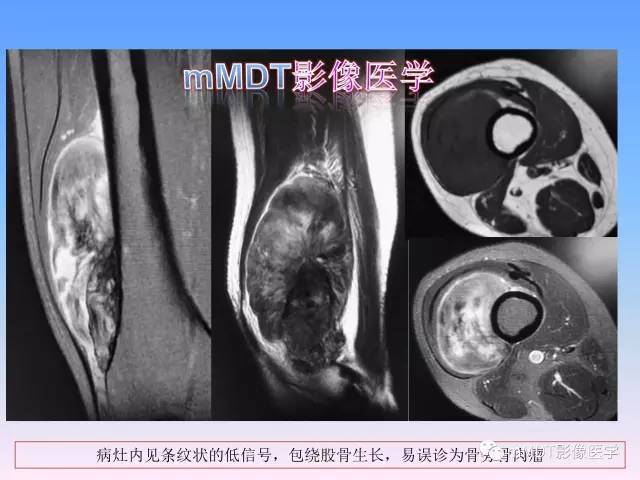 轻松诊断这三个不常见位置的骨巨细胞瘤