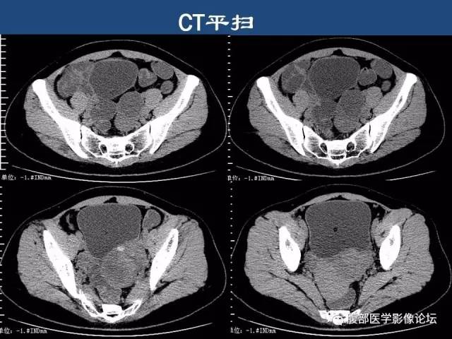 【病例】卵巢甲状腺肿1例CT及MR 【病例】卵巢甲状腺肿1例CT及MR