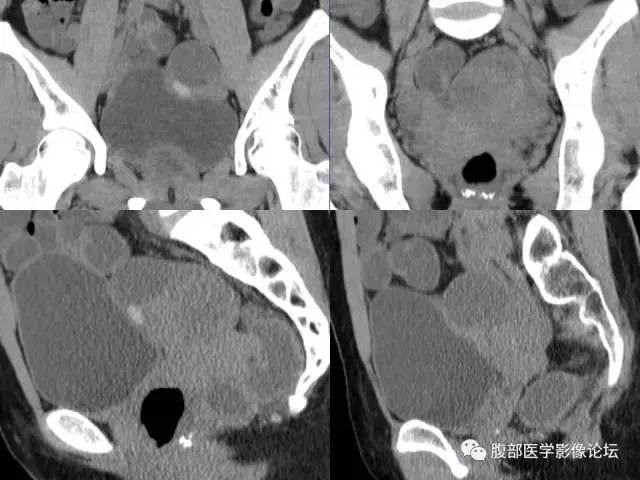 【病例】卵巢甲状腺肿1例CT及MR 【病例】卵巢甲状腺肿1例CT及MR