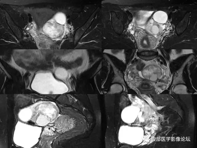 【病例】卵巢甲状腺肿1例CT及MR 【病例】卵巢甲状腺肿1例CT及MR