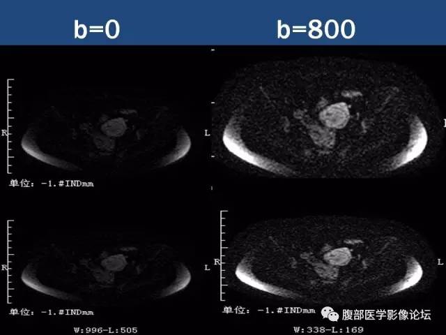 【病例】卵巢甲状腺肿1例CT及MR 【病例】卵巢甲状腺肿1例CT及MR