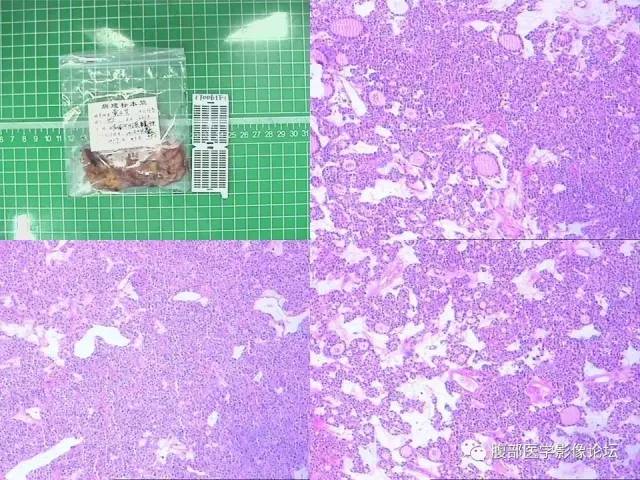 【病例】卵巢甲状腺肿1例CT及MR 【病例】卵巢甲状腺肿1例CT及MR