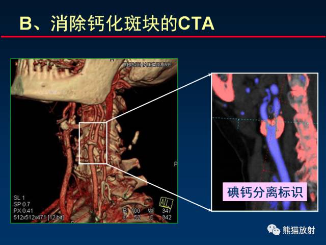 【PPT】CT能量成像的理解与应用