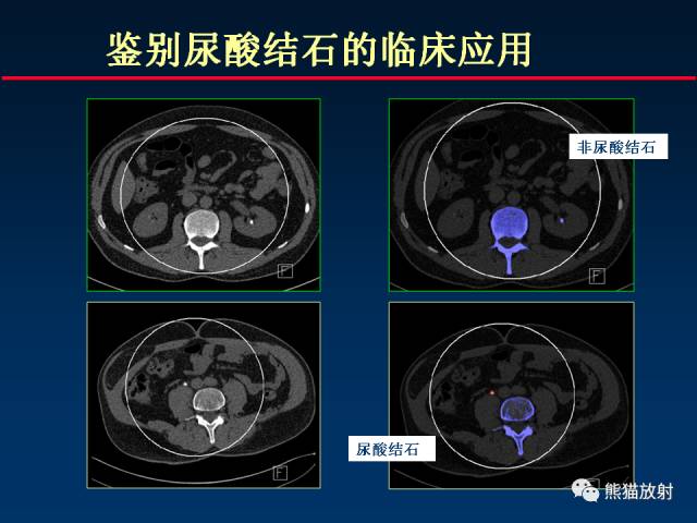【PPT】CT能量成像的理解与应用