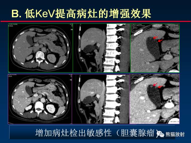 【PPT】CT能量成像的理解与应用