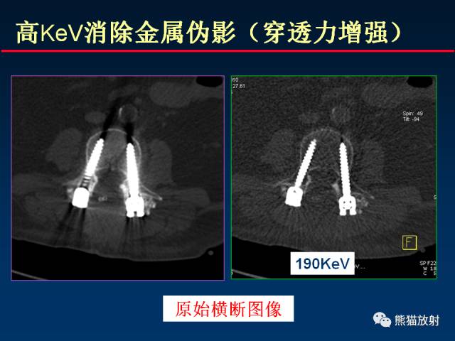 【PPT】CT能量成像的理解与应用