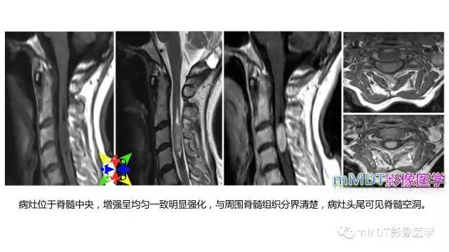【PPT】脊髓内肿瘤性病变MRI表现