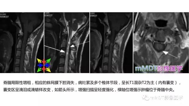 【PPT】脊髓内肿瘤性病变MRI表现