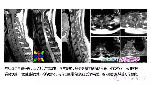【PPT】脊髓内肿瘤性病变MRI表现
