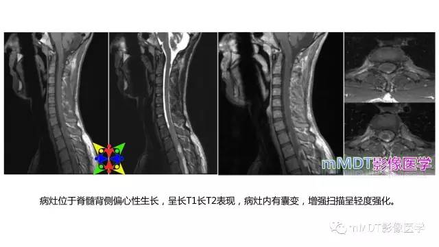 【PPT】脊髓内肿瘤性病变MRI表现