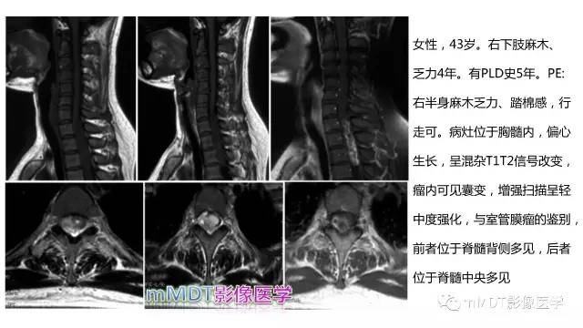 【PPT】脊髓内肿瘤性病变MRI表现