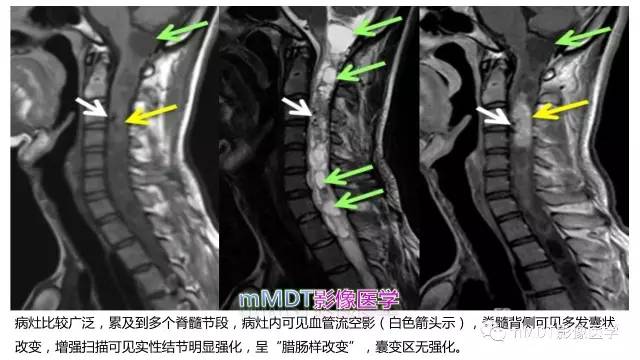 【PPT】脊髓内肿瘤性病变MRI表现