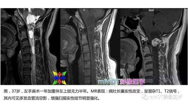 【PPT】脊髓内肿瘤性病变MRI表现