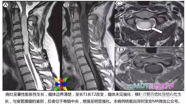 【PPT】脊髓内肿瘤性病变MRI表现