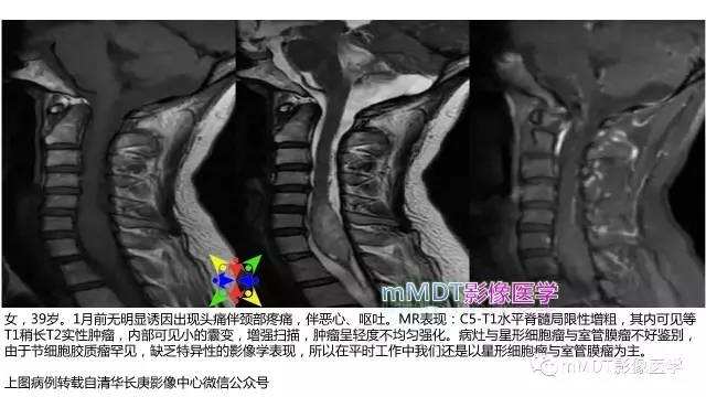 【PPT】脊髓内肿瘤性病变MRI表现