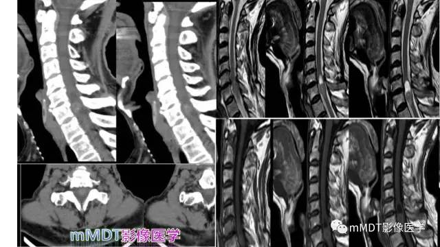 【PPT】脊髓内肿瘤性病变MRI表现