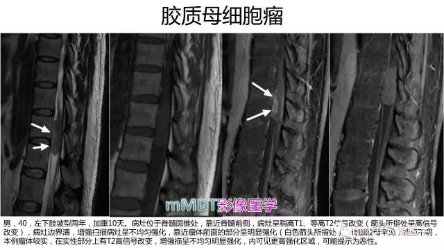 【PPT】脊髓内肿瘤性病变MRI表现