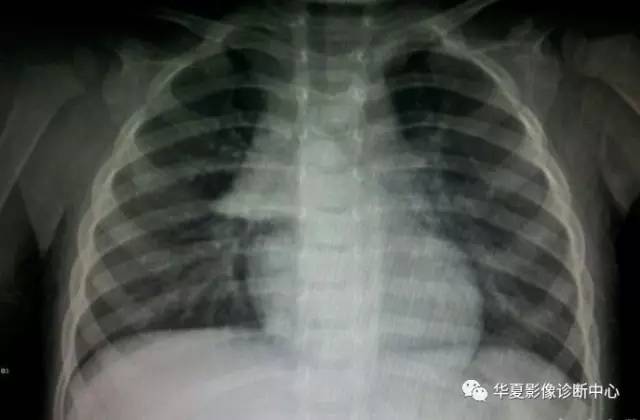 胸腺瘤的分类、分期及CT表现归纳