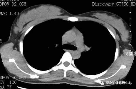 胸腺瘤的分类、分期及CT表现归纳