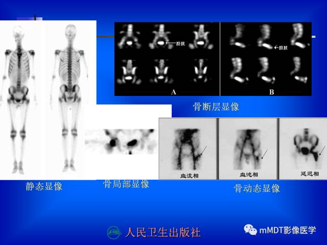 【PPT】骨骼系统核医学