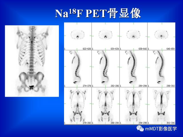 【PPT】骨骼系统核医学