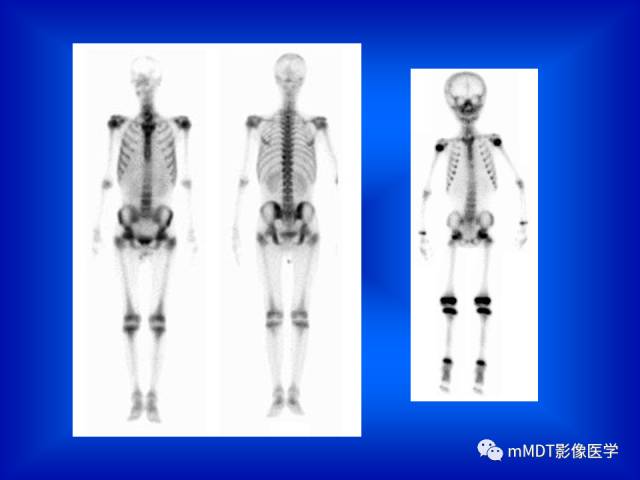 【PPT】骨骼系统核医学