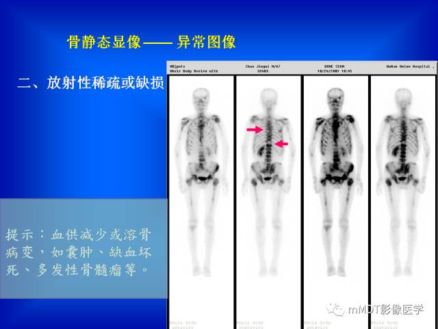 【PPT】骨骼系统核医学