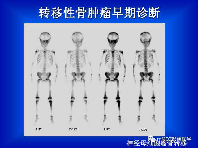 【PPT】骨骼系统核医学