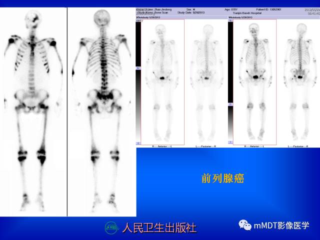 【PPT】骨骼系统核医学