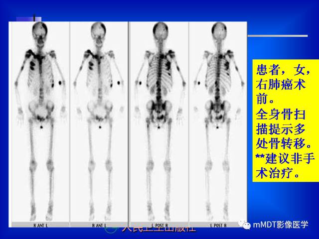 【PPT】骨骼系统核医学
