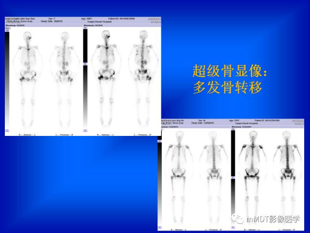 【PPT】骨骼系统核医学