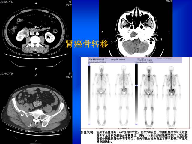 【PPT】骨骼系统核医学