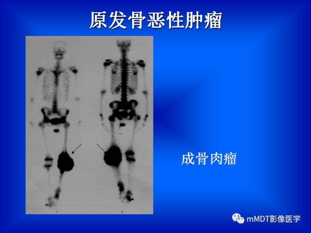 【PPT】骨骼系统核医学