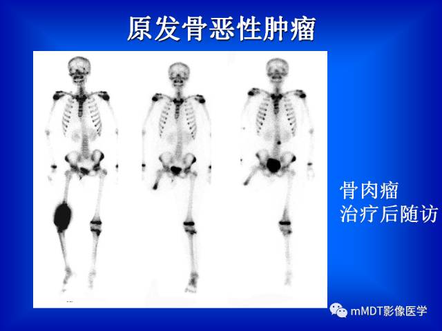【PPT】骨骼系统核医学
