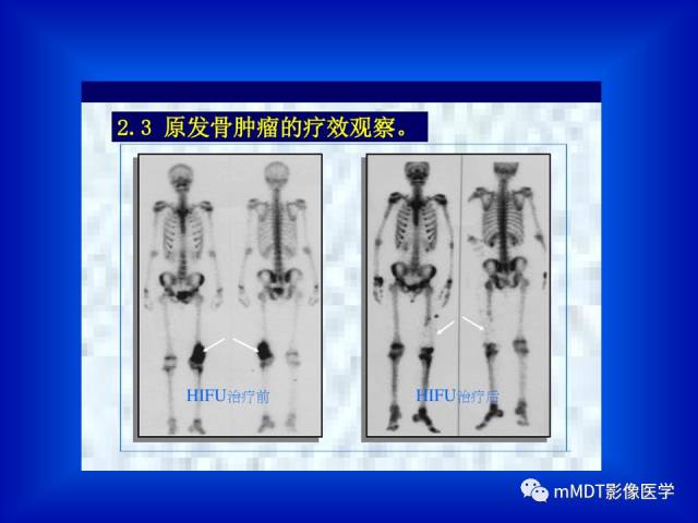 【PPT】骨骼系统核医学