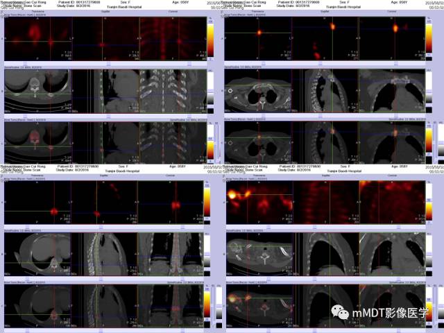 【PPT】骨骼系统核医学