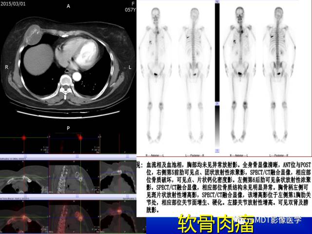 【PPT】骨骼系统核医学