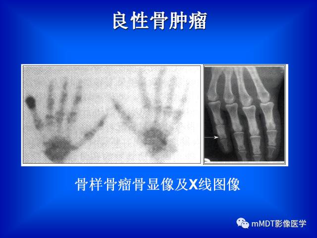 【PPT】骨骼系统核医学
