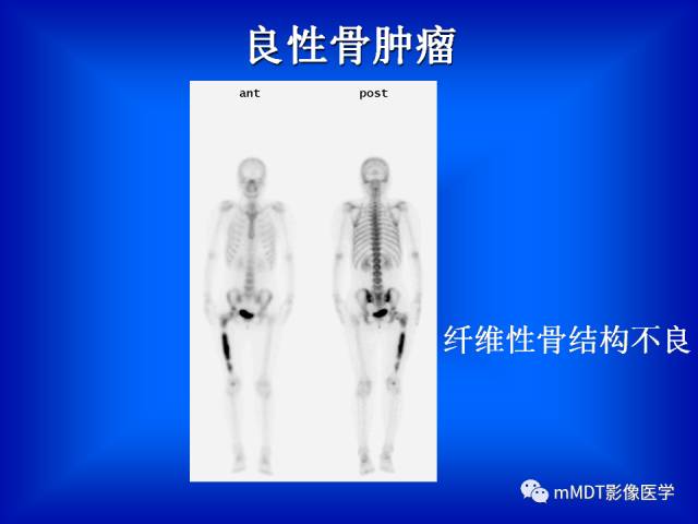 【PPT】骨骼系统核医学