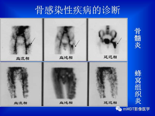 【PPT】骨骼系统核医学